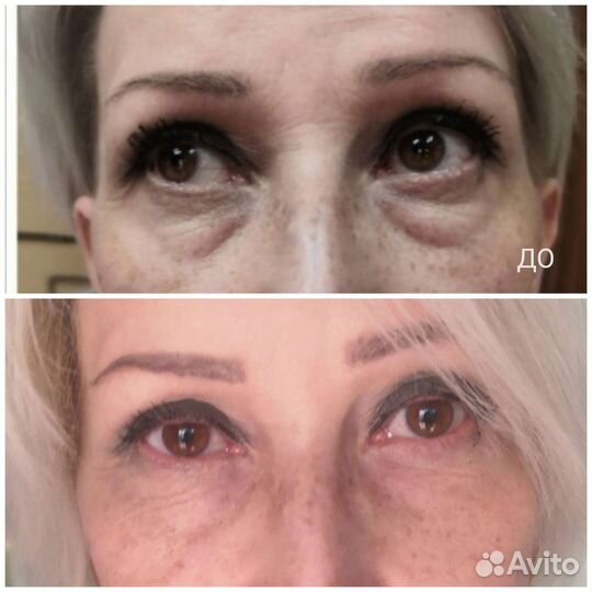 Блефаропластика без операции, нависшее веко, мешки