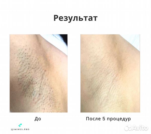 Аппарат для эпиляции lumines Макс’Про 2000