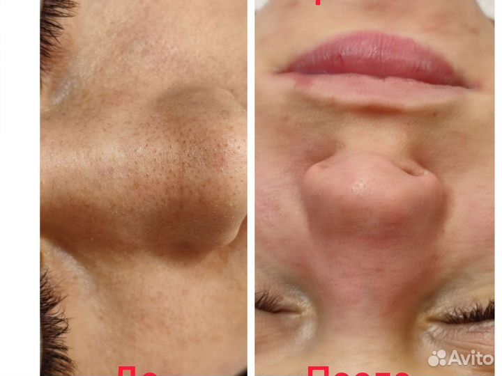 Косметолог пирсинг