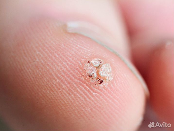 Удаление бородавок