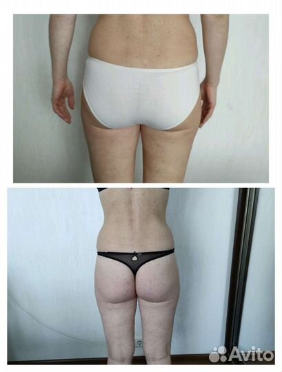 LPG массаж, прессотерапия, миостимуляция