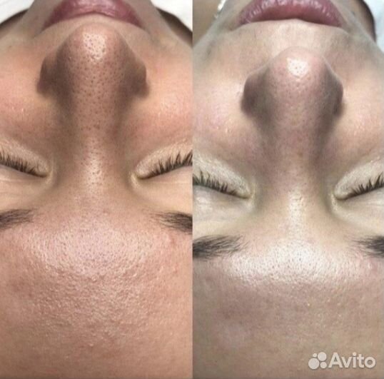 УЗ чистка лица, фонофорез, LED терапия