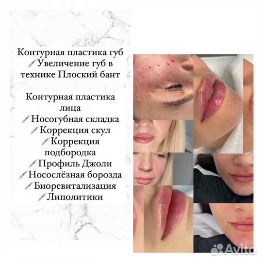 Увеличение губ