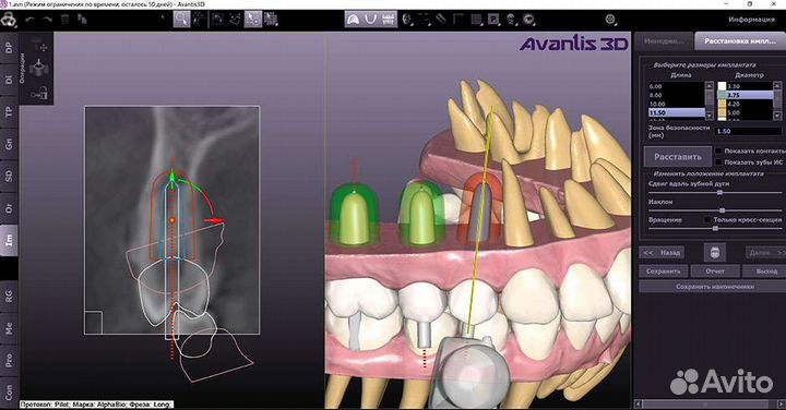 Программа для стоматологов Avantis 3D