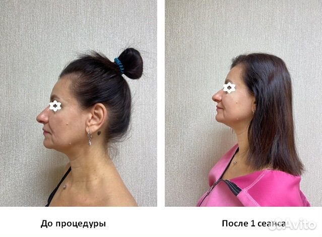 Ручная пластика лица