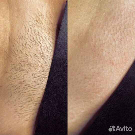 Шугаринг: глубокое бикини