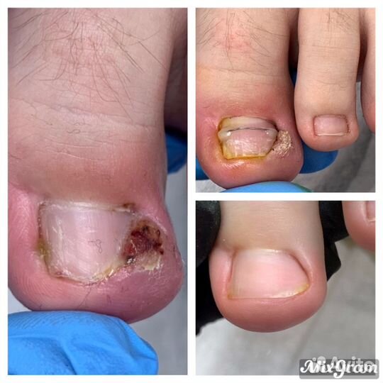 Медицинский педикюр. Подолог