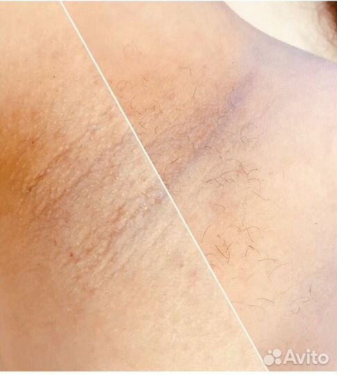 Шугаринг: глубокое бикини