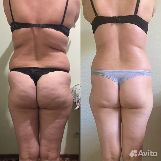 Антицеллюлитный массаж