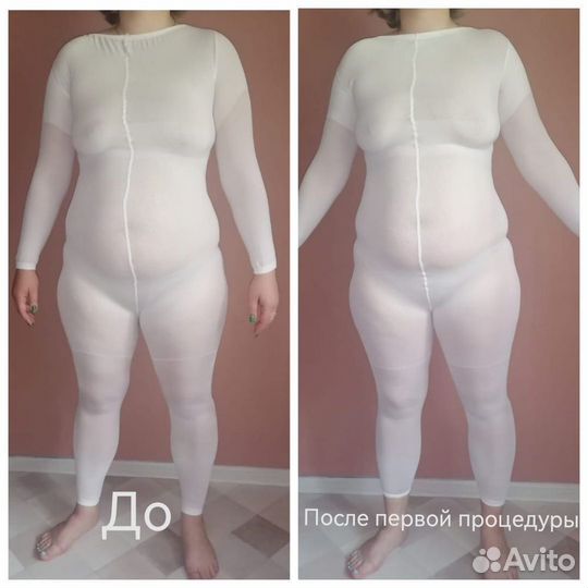 LPG массаж