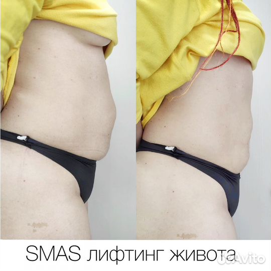 Коррекция фигуры аппаратами