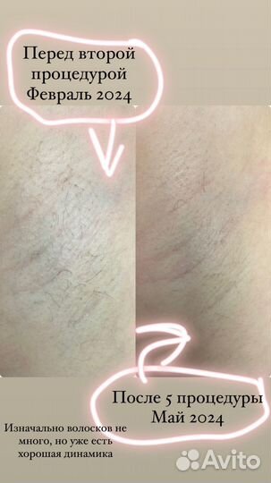 Электроэпиляция