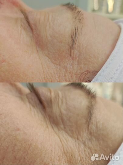 Аппаратное омоложение сфт