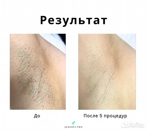 Диодный лазер для эпиляции люминес Макс-Ван 1200W