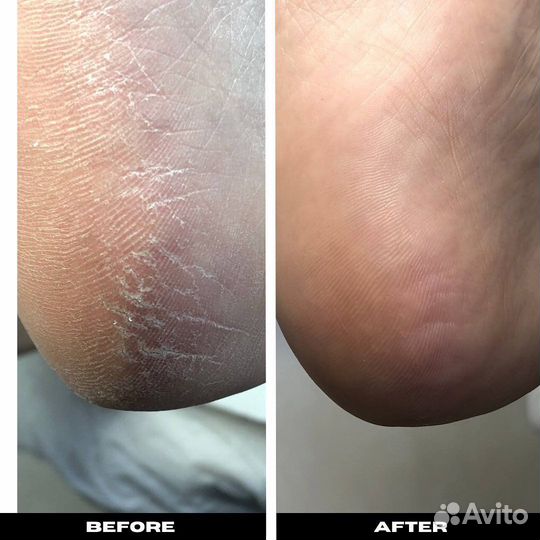 Медицинский препаратный педикюр, подолог