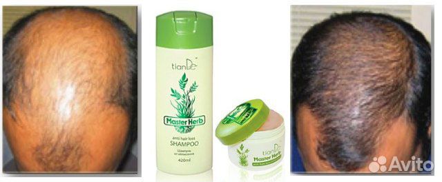 Шампунь и бальзам от облысения, выпадения волос