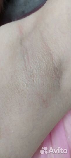 Шугаринг эпиляция