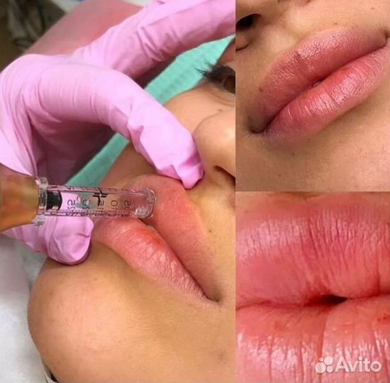 Биоревитализация