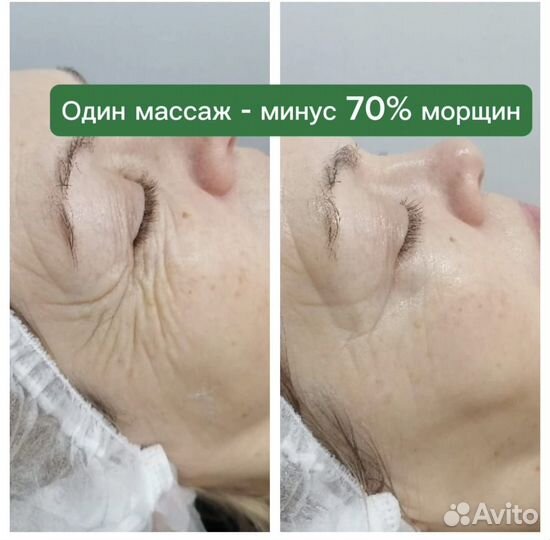 Массаж лица. Подтяжка лица. RF-лифтинг