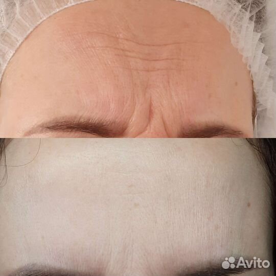 Биоревитализация