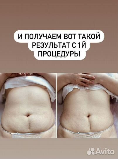 Индиба похудение, коррекция