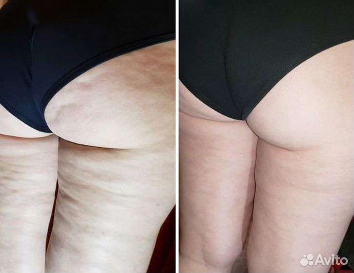 Антицеллюлитный массаж