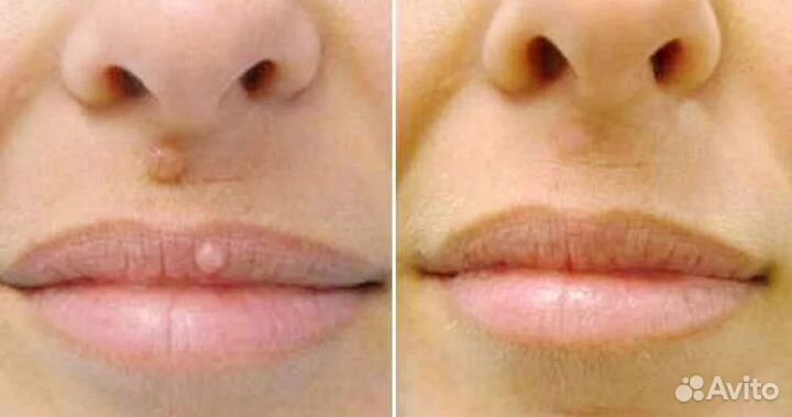 Удаление бородавок, родинок, папиллом