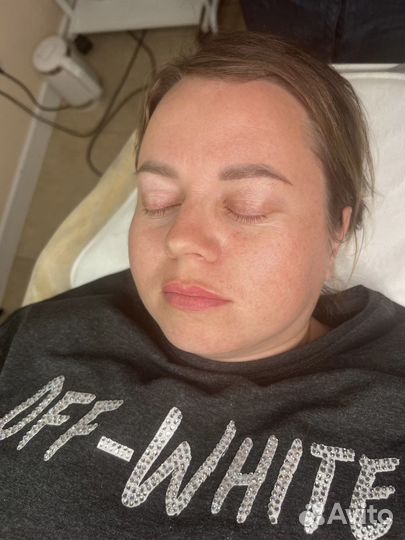 Увеличение губ