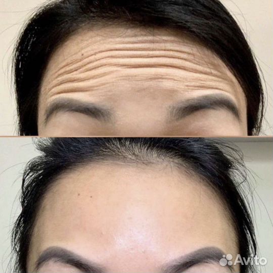 Ботокс для лица, ботулинотерапия