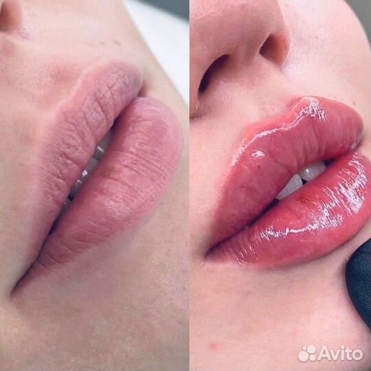 Ультразвуковая чистка лица