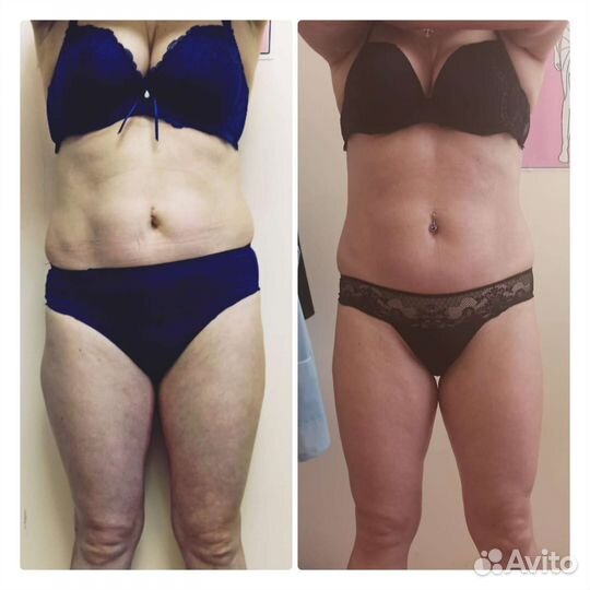 Lpg массаж /Velashape