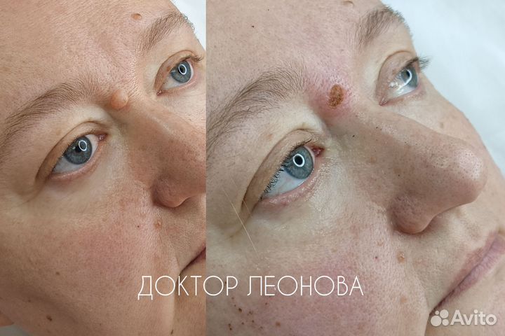 Удаление родинок папиллом у дерматолога