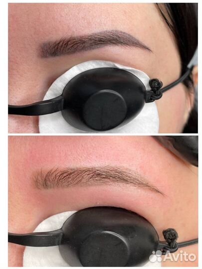 Удаление татуажа и удаление тату