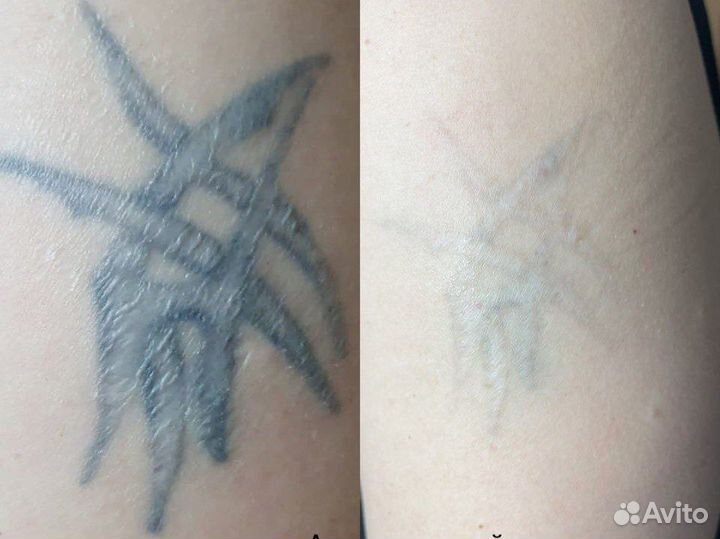 Лазерное удаление татуажа и татуировок