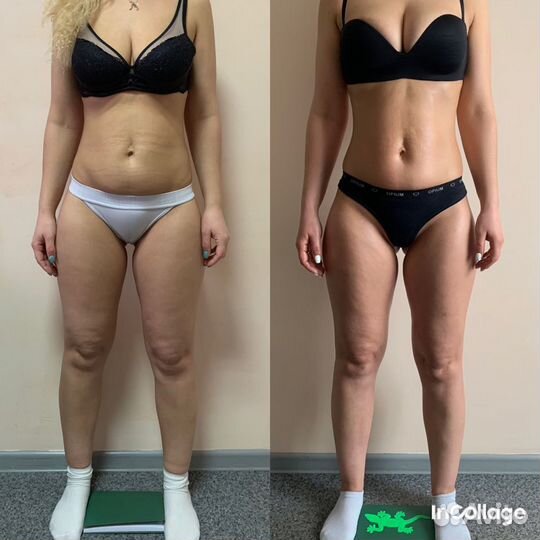 Антицеллюлитный массаж