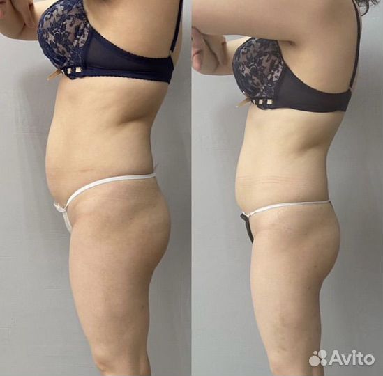 Вакуумный массаж Турбомассаж коррекция фигуры