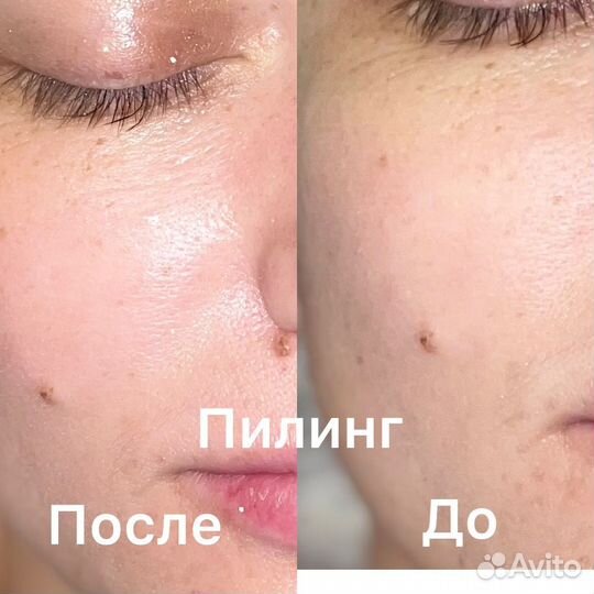 Увеличение губ, Монако, Ботокс, мезо, био