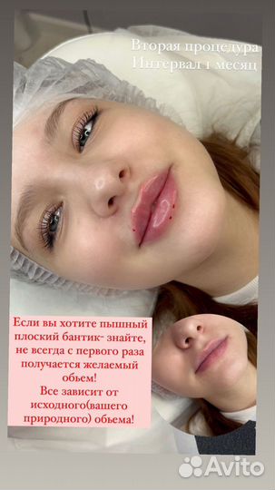 Увеличение Губы.Ботокс.Чистка лица
