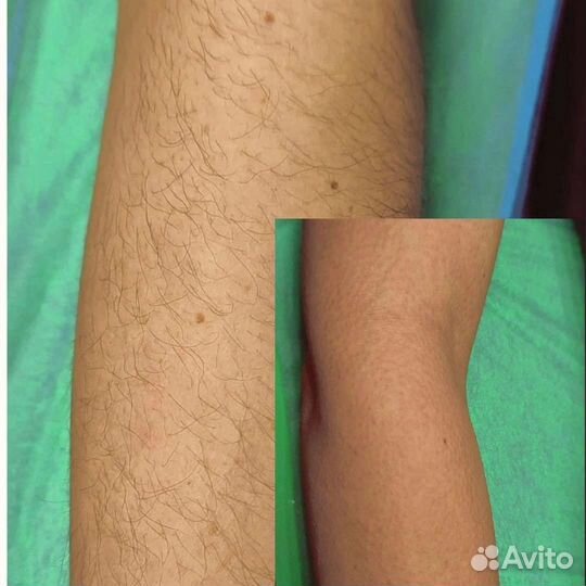 Шугаринг: глубокое бикини