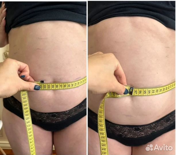 Безоперационная липосакция