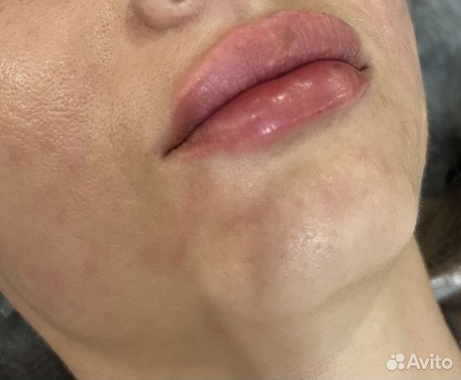 Чистка лица пилинг калининград