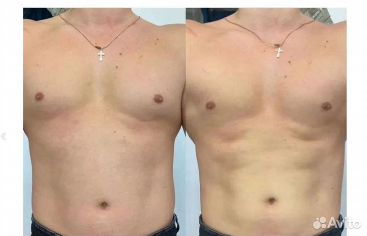 Плоский живот - размер за 1 процедуру в Казани