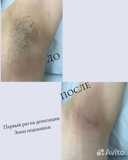 Шугаринг/Депиляция воском