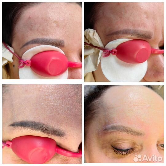 Удаление татуажа лазером и ремувером