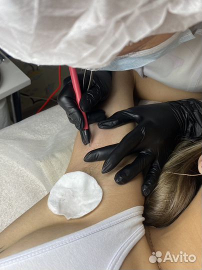 Обучение электроэпиляции