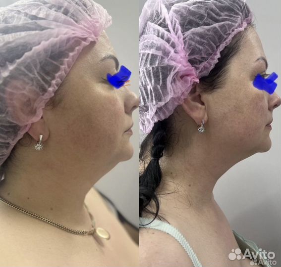Аппаратное похудение за один сеанс