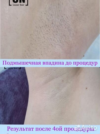 Лазерная эпиляция на диодном лазере