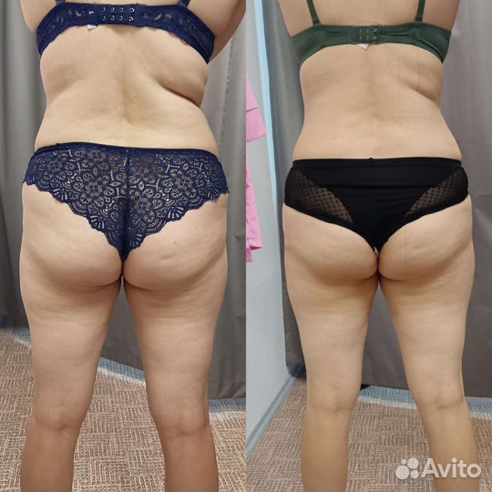 Lpg массаж /Velashape