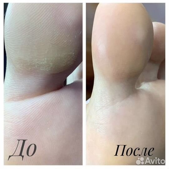 Инновационный Smart-педикюр