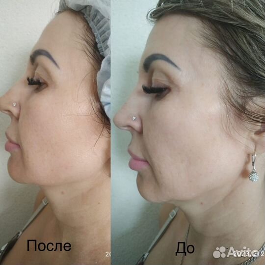 Омоложение Подтяжка лица СМАС лифтинг